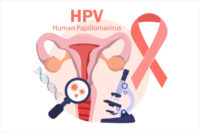 HPV (Human Papillomavirus) Cervical cancer screening and treatment, PAP test, viruses Some strains infect genitals and can cause cervical cancer. women health concept.